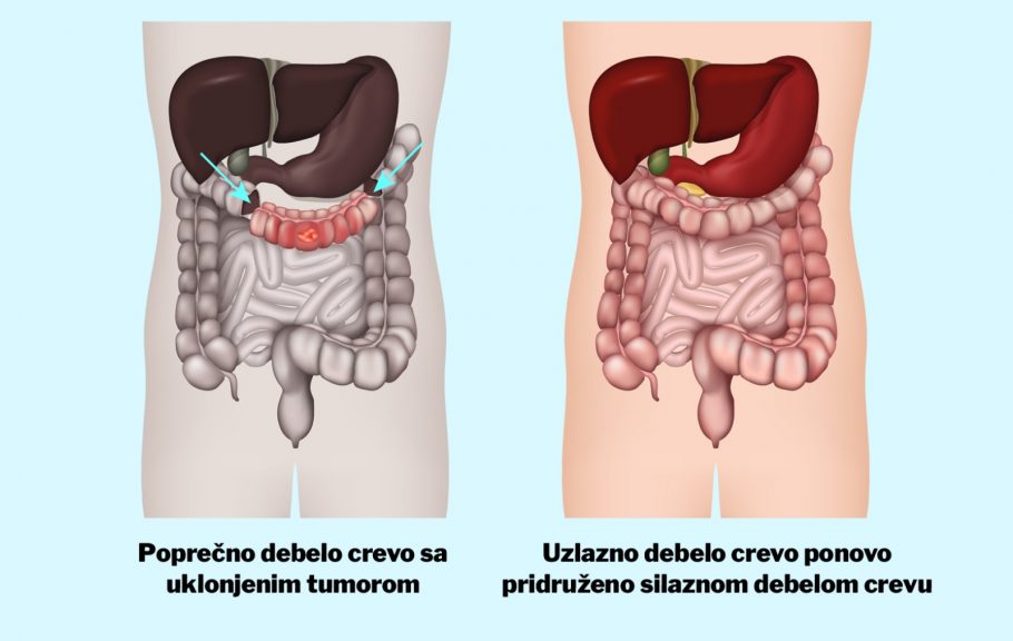 kolektomija-debelo crevo-tumor debelog creva