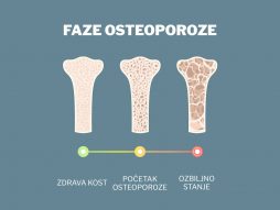 osteoporoza-kosti- zdravlje kostiju