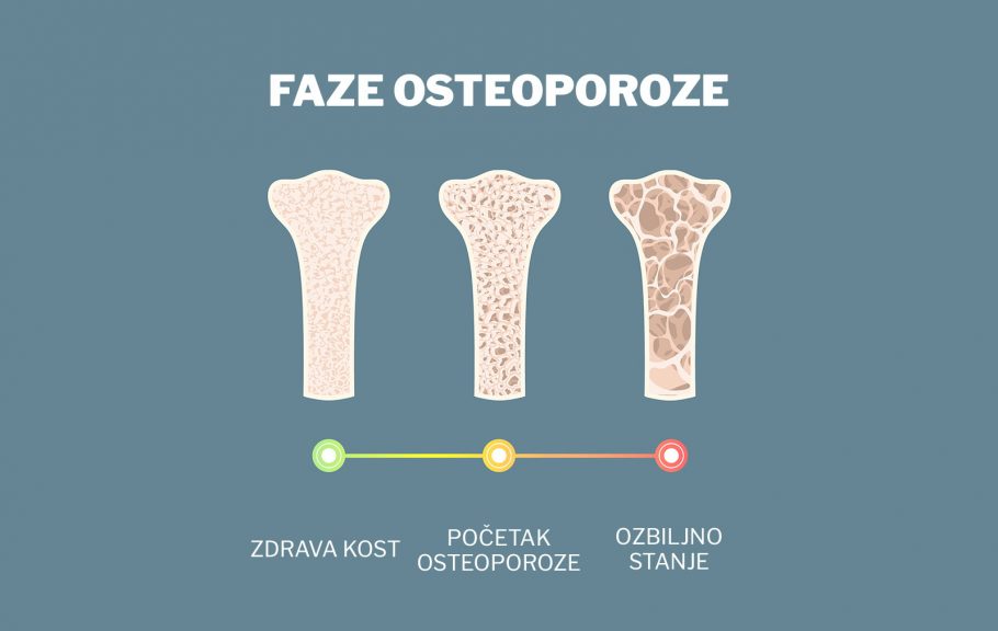 osteoporoza-kosti- zdravlje kostiju