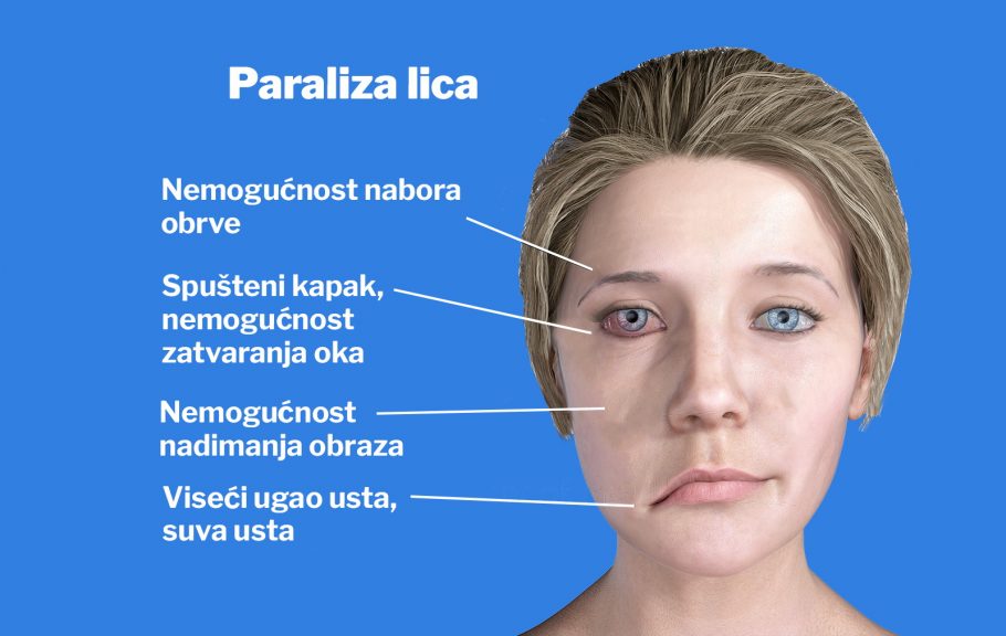 paraliza lica-pareza-facijalis