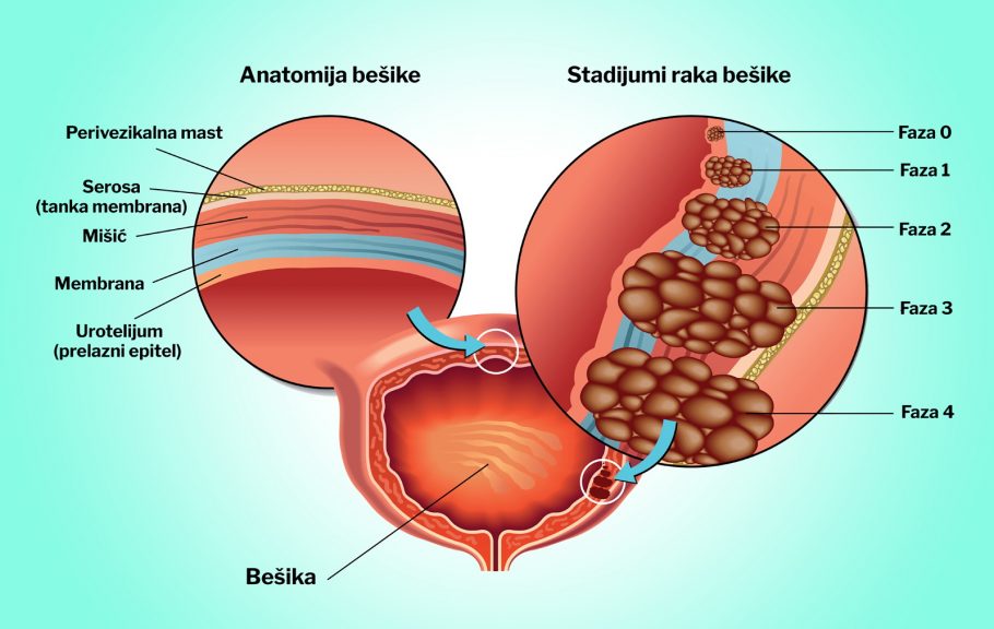 bešika-rak-rak bešike