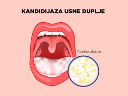 kandida- usna duplja- gljivična infekcija