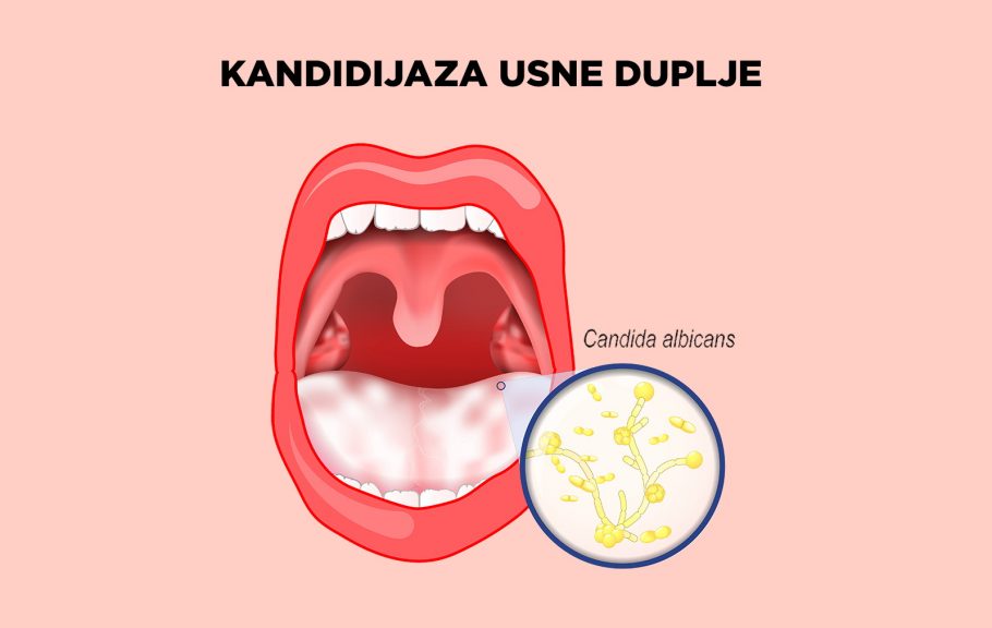 kandida- usna duplja- gljivična infekcija