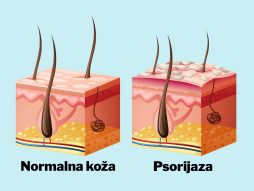 psorijaza- bolest kože- kardivaskularni problemi