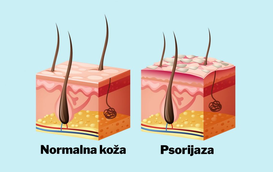 psorijaza- bolest kože- kardivaskularni problemi