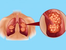 rak pluća- agresivan karcinom pluća- mikrocelularni rak