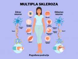 multipla skleroza-depresija- umor-gubitak posla