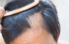 alopecija-gubitak kose- opadanje kose-pečati