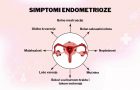 endometrioza- simptomi- lečenje