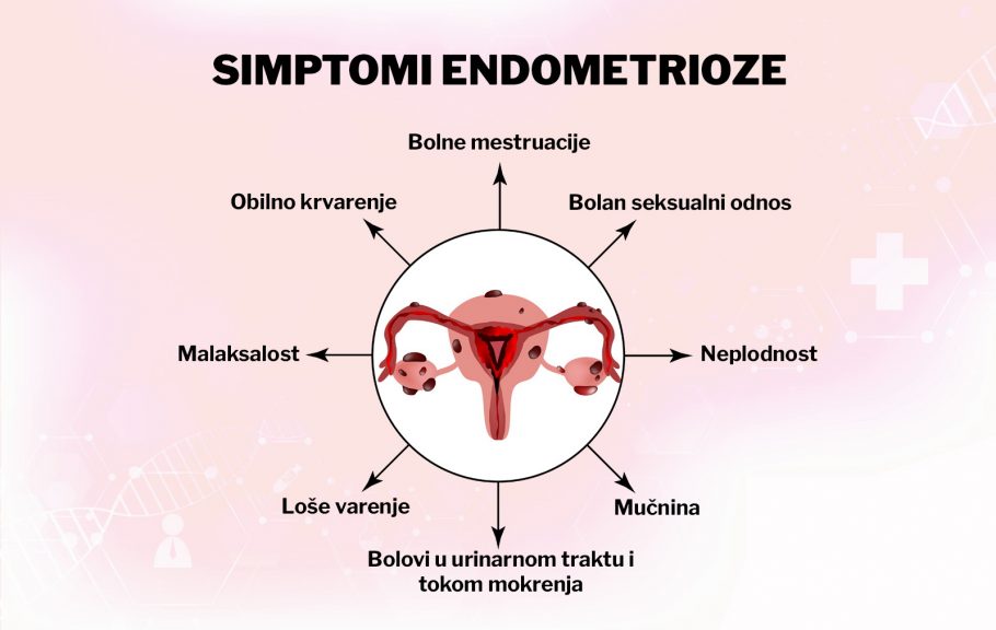 endometrioza- simptomi- lečenje