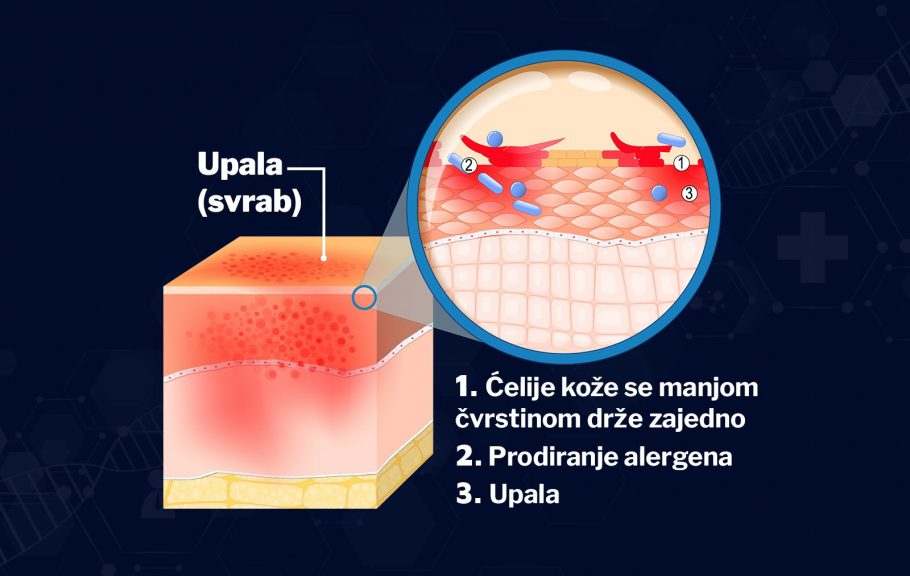 duringova bolest - celijakija-dermatitis