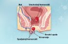 hemoroidi-trudnoća.naprezanje-pražnjenje creva