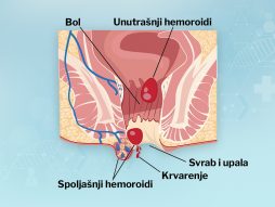 hemoroidi-trudnoća.naprezanje-pražnjenje creva
