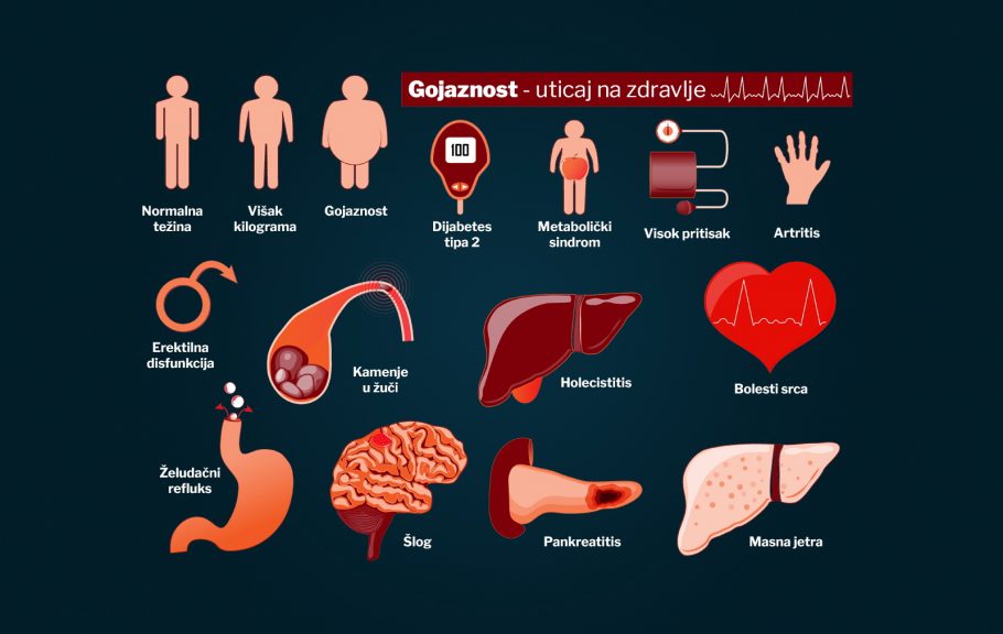 gojaznost i žučna kesa- dijabetes i problemi sa žučnom kesom