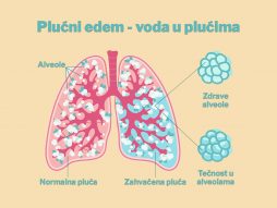 voda u plućima- edem pluća- otežano disanje