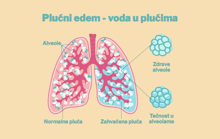 voda u plućima- edem pluća- otežano disanje