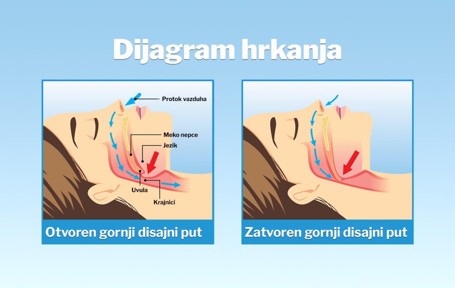 hrkanje- sleep apneja- žene