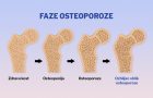 osteoporoza-osteopenija- razgradnja kostiju
