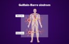 Guillain-Barre sindrom- covid 19-okidač