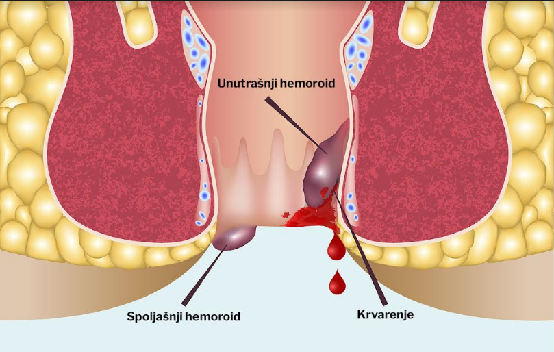 hemoroidi