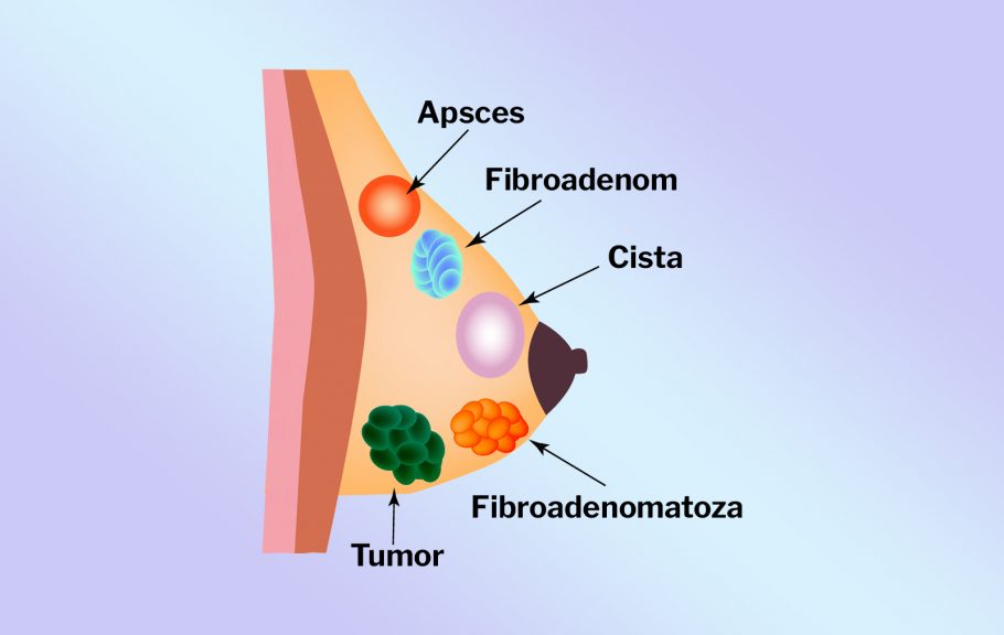 tumor dojke