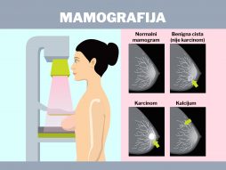 mamografija