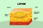 lipom