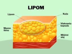 lipom