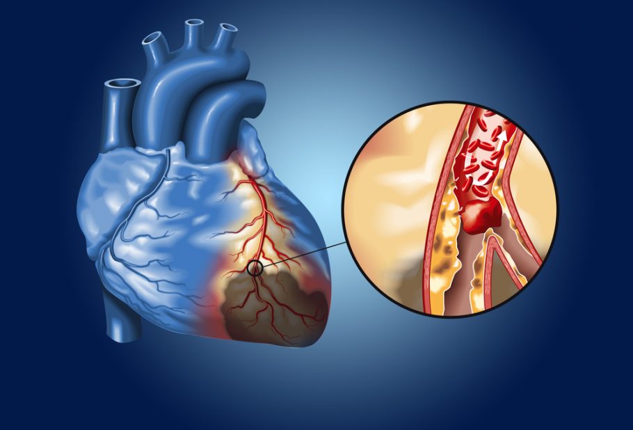 embolus