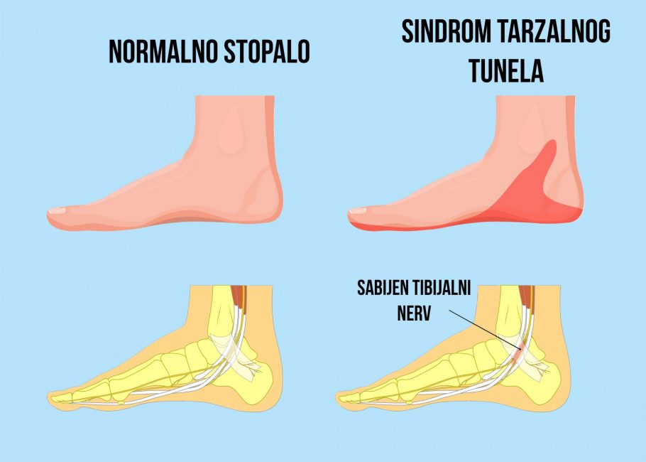 sindrom tarzalnog tunela