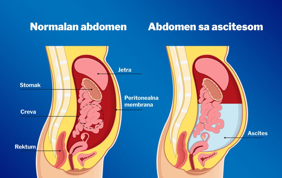 ascites