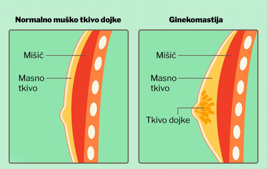 ginekomastija