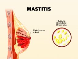 Mastitis