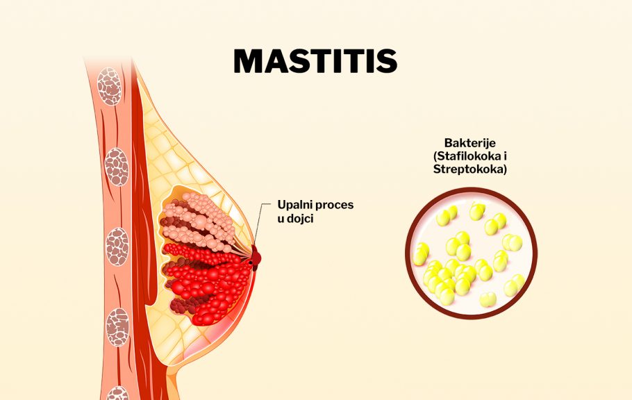 Mastitis