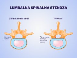 Lumbalna spinalna stenoza