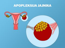 apopleksija jajnika