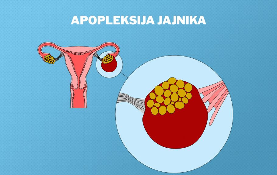 apopleksija jajnika