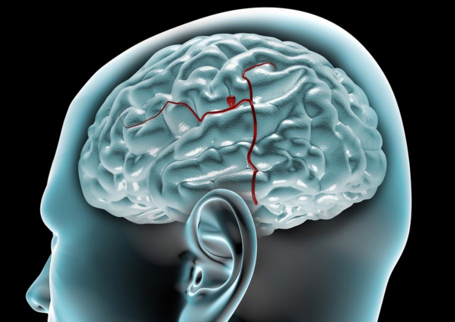 Cerebralne kavernozne malforacije