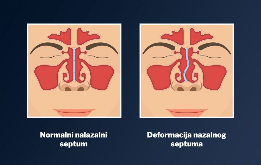 Deformacija septuma