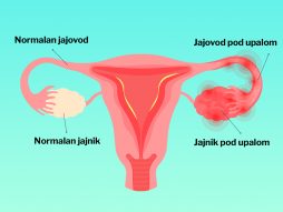 Upala jajnika