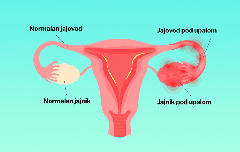 Upala jajnika