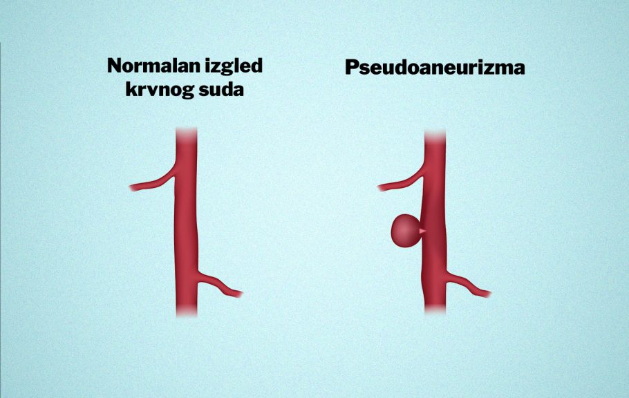 pseudoaneurizma