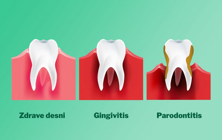 gingivitis