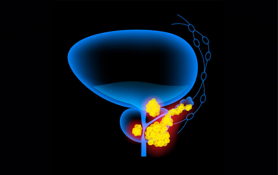 rak prostate