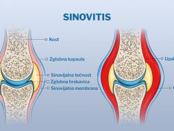 sinovitis