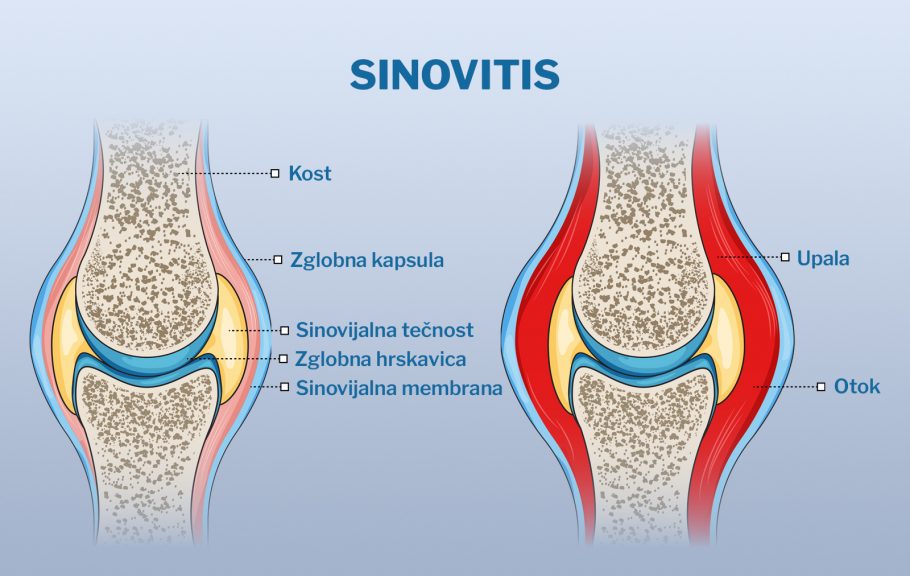 sinovitis