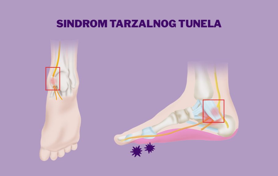 sindrom tarzalnog tunela