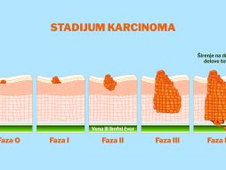 stadijum karcinoma