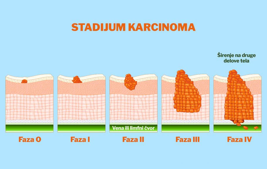 stadijum karcinoma