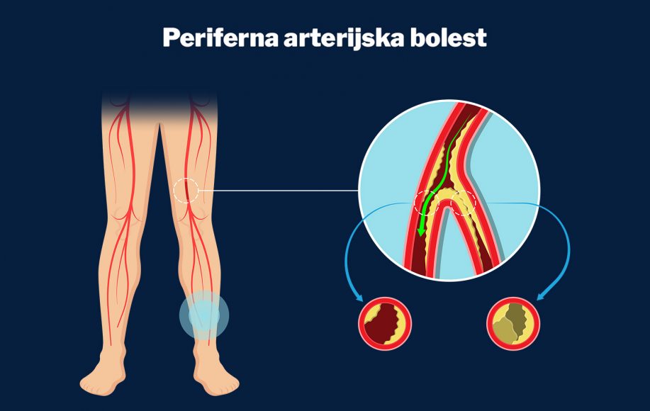 bolest perifernih arterija